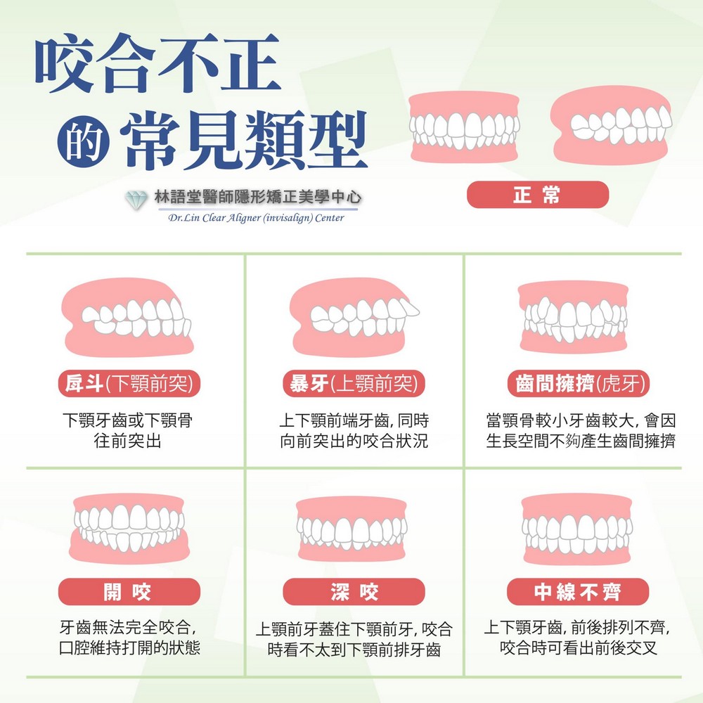 咬合不正的常見類型