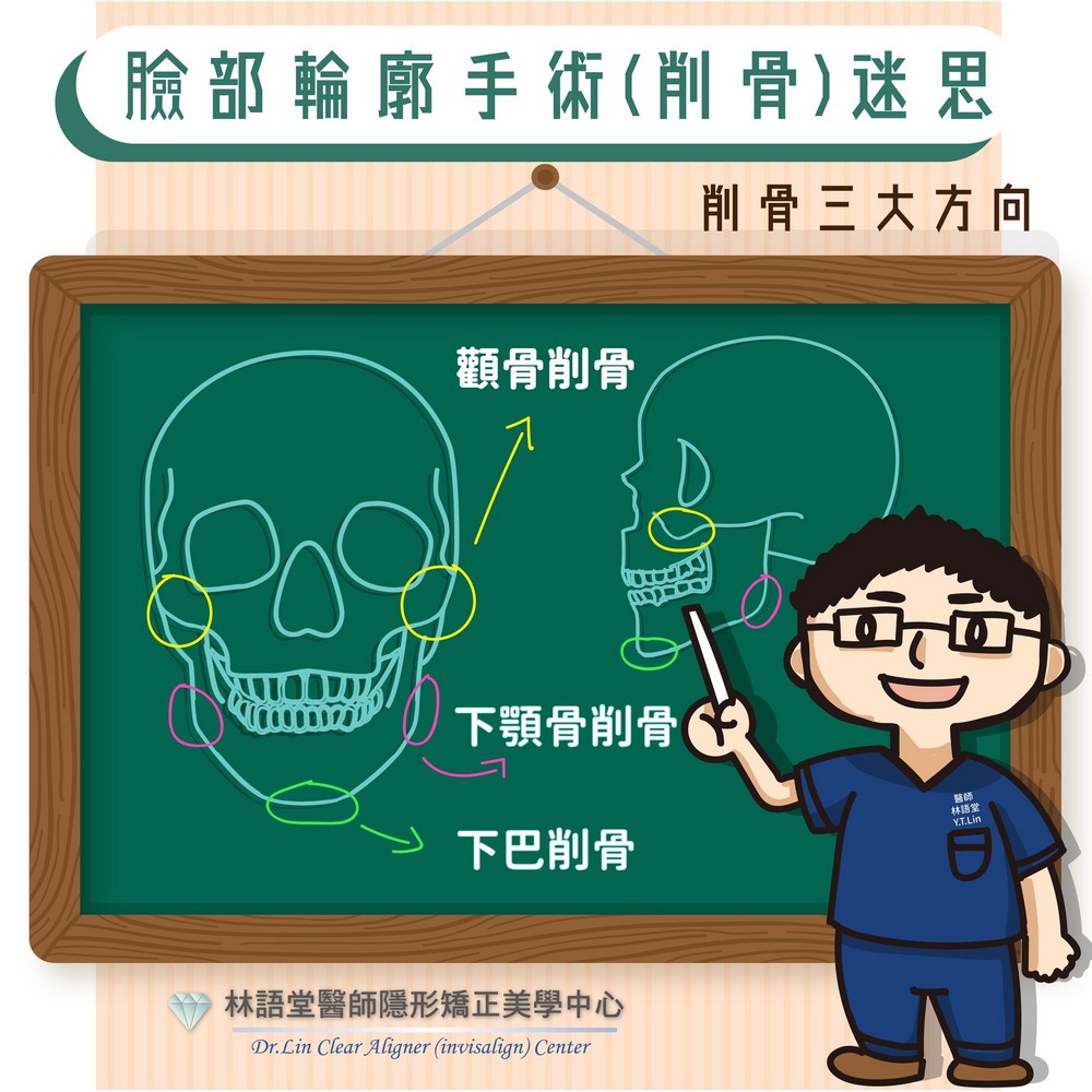 臉部輪廓手術(削骨)迷思