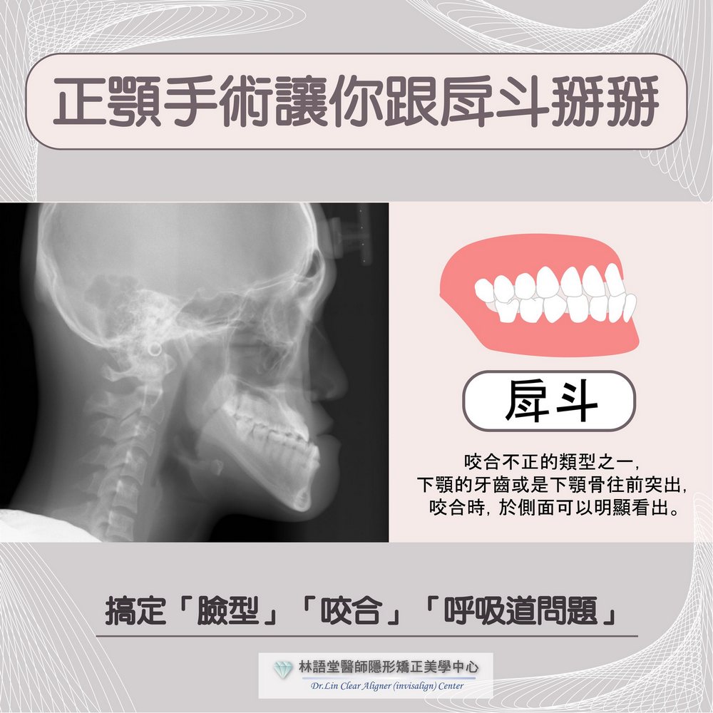跟戽斗掰掰-正顎手術