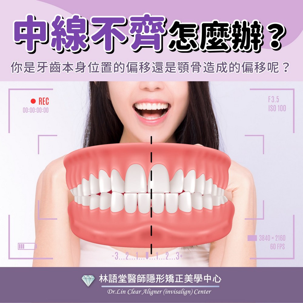 中線不齊怎麼辦？ 我需要牙齒矯正嗎？