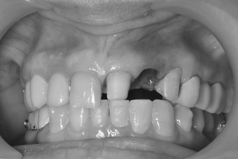 立即式植牙(即拔即種)