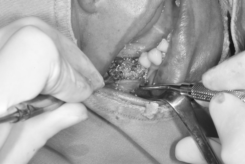 齒槽骨再生術(補骨)