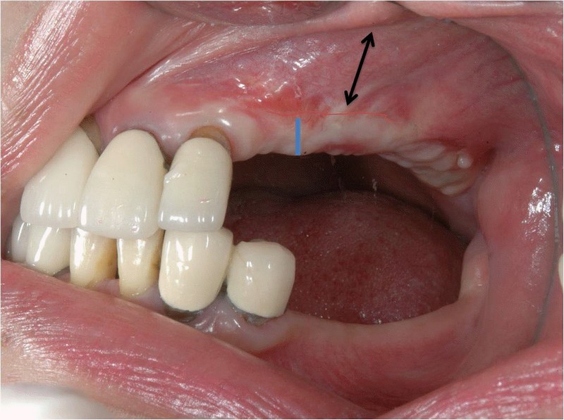 牙齦移植術(補肉)