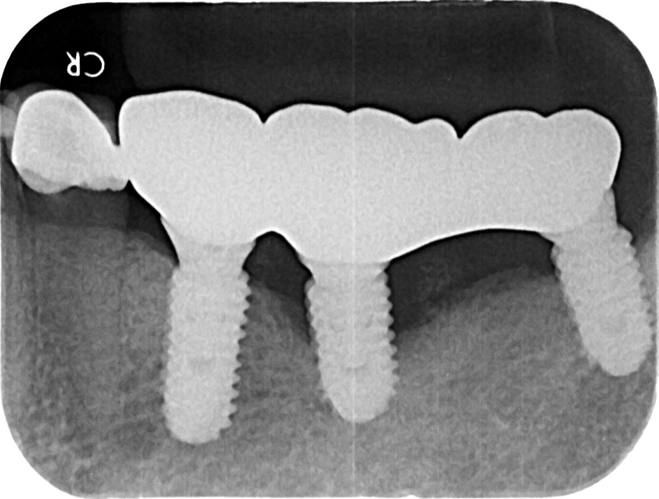 植體周圍炎處理