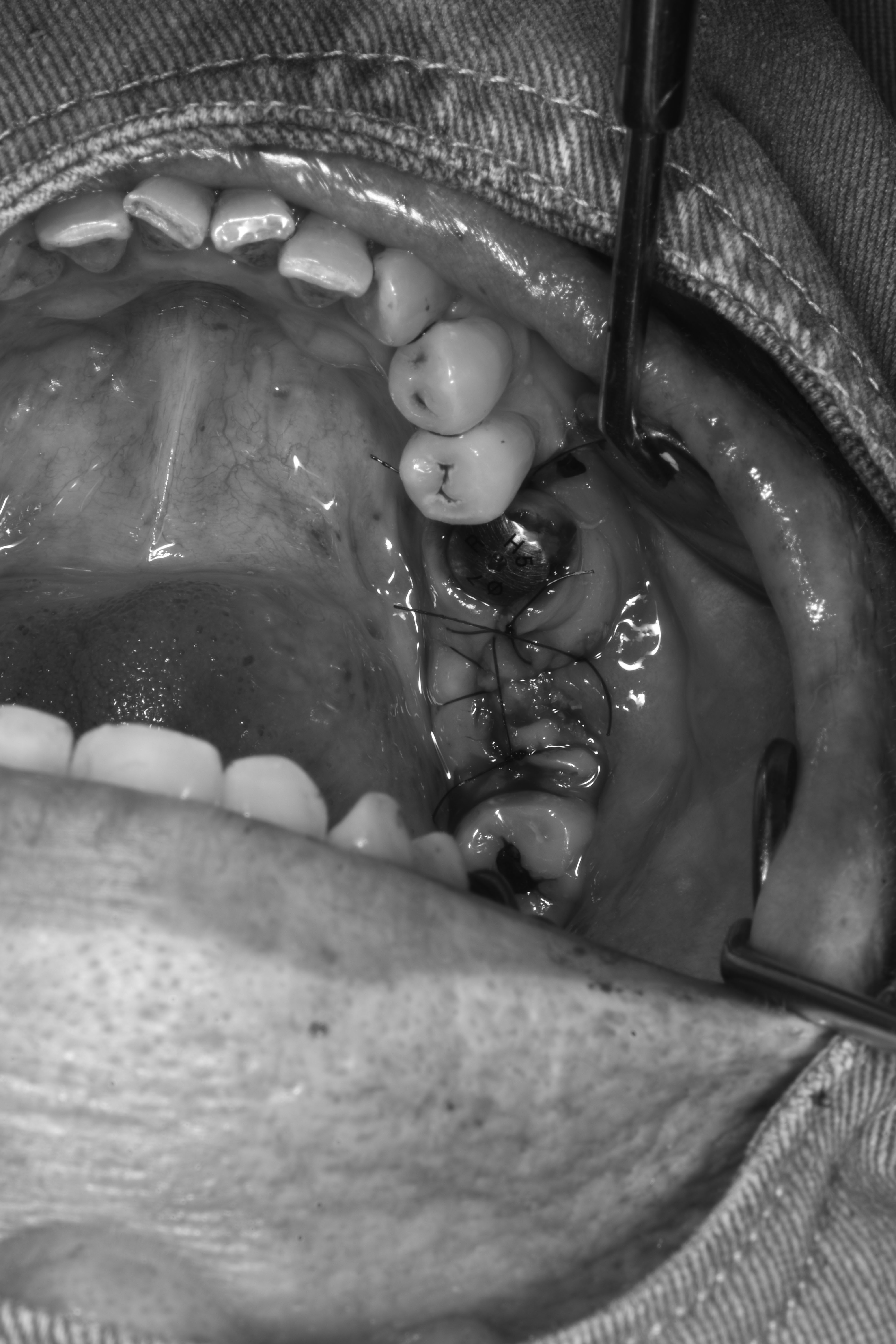 齒槽骨保存術(拔完牙立即補骨)